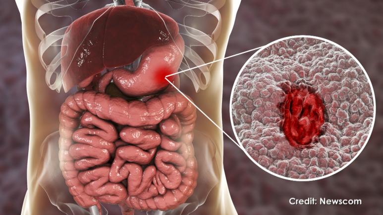 stomach ulcer illustration