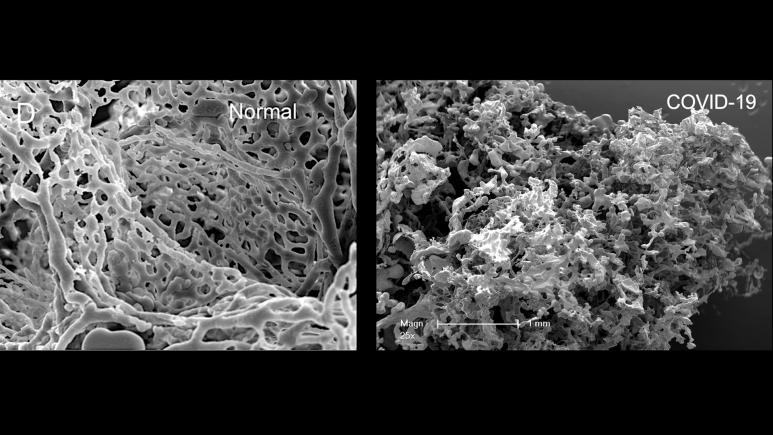 Lungs before and after Covid-19